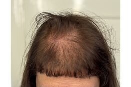 HAAR.INK in Schagen trekt vrouwen uit heel Nederland met unieke aanpak micro haarpigmentatie